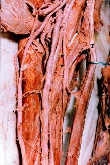 A photograph of the left arm of an adult cadaver, showing coracobrachialis muscle which widely arises by a single head (A) from the medial side of the tendon of the short head of the biceps brachii