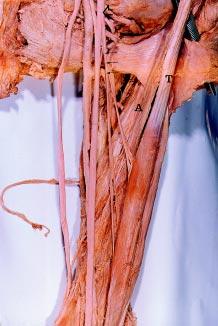 Mostafa M El-Naggar, Morphology of coracobrachialis Figure 7.