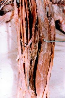 medially in front of the brachial artery and median nerve to blend with the deep fascia on the medial aspect of the arm. Figure 8.