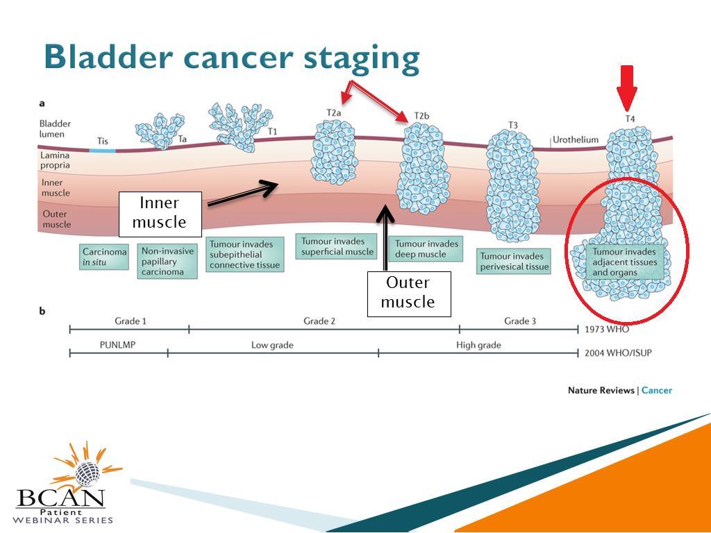 our male patients. But we know that if bladder cancer can be caught early, it is very manageable and there s an excellent prognosis for our women patients.