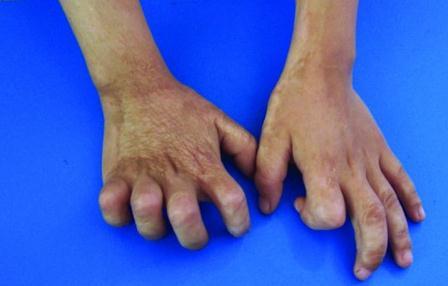 CONTRACTURE SCARS When the skin is burned, a scar will form
