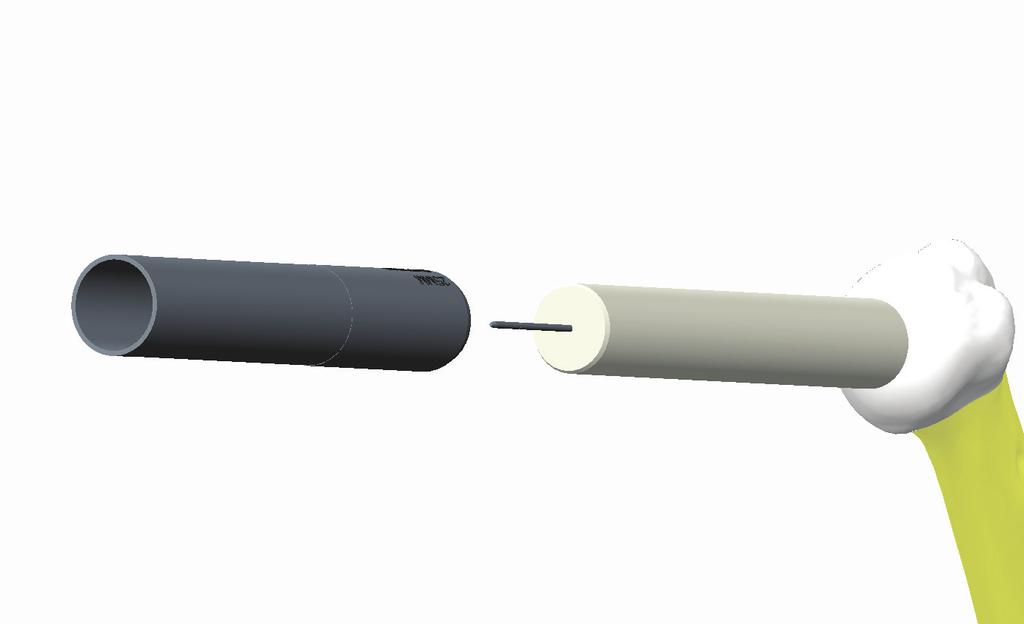 Technique 3. Remove the drill guide and place the appropriately sized guide tube over the pilot nail.