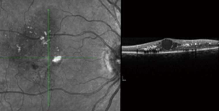 demonstrating focal leakage arising from microaneurysms (white arrows); F, G: Diffuse leakage arising from the walls of capillaries. lines) compared to the 1490 eyes without treatment.