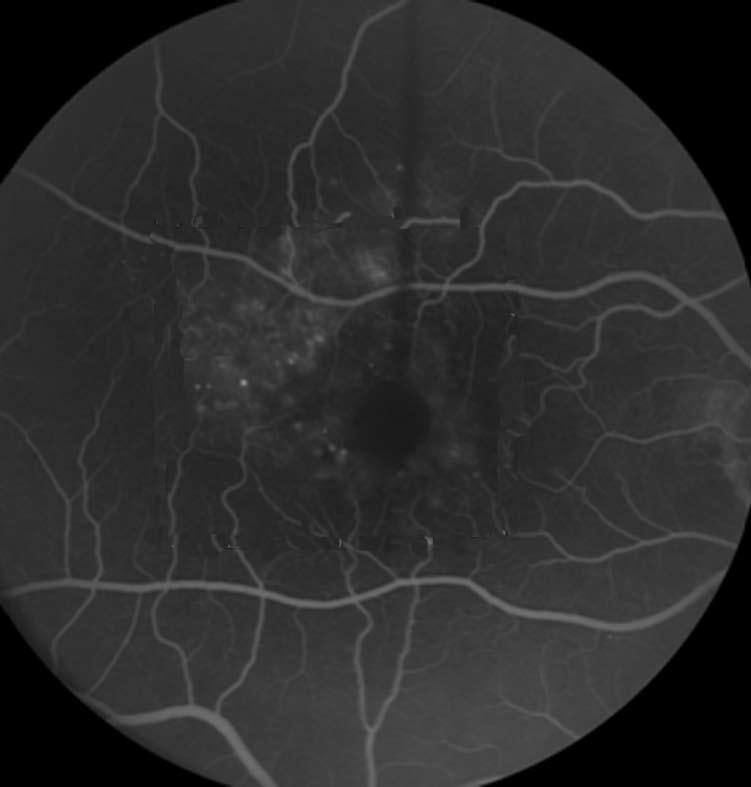 Nonetheless, despite these promising results, laser photocoagulation for DME leaves the majority of patients with little hope for an improvement in vision.
