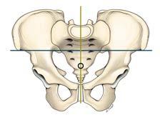 PINCER DIAGNOSIS 120 cm Well-centered AP view of the pelvis: distance between the