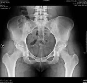 NJ, Trousdale RT, CORR 2003) Reclination of the pelvis can underestimate the