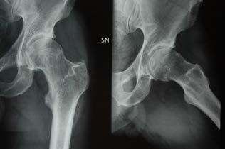 40 Osteoarthritis (
