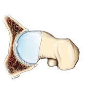 retroversion and protrusion. Early impingement labrum/neck.