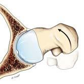 impingement: aspheric head/neck junction; there is a