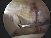 acetabular cartilage: femoroacetabular impingement