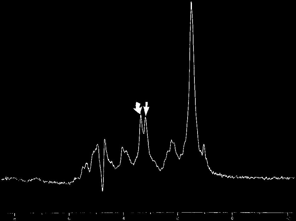 1932 MAHESHWARI AJNR: 21, November/December 2000 FIG 2. Glomus tumor. In vitro 1D proton MR spectrum (2000/ 136/128) shows elevation of the Cho/Cr ratio.