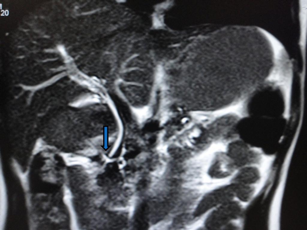 Fig. 1: An 18-year-old female with a clinical history of recurrent pancreatitis coronalmrcp