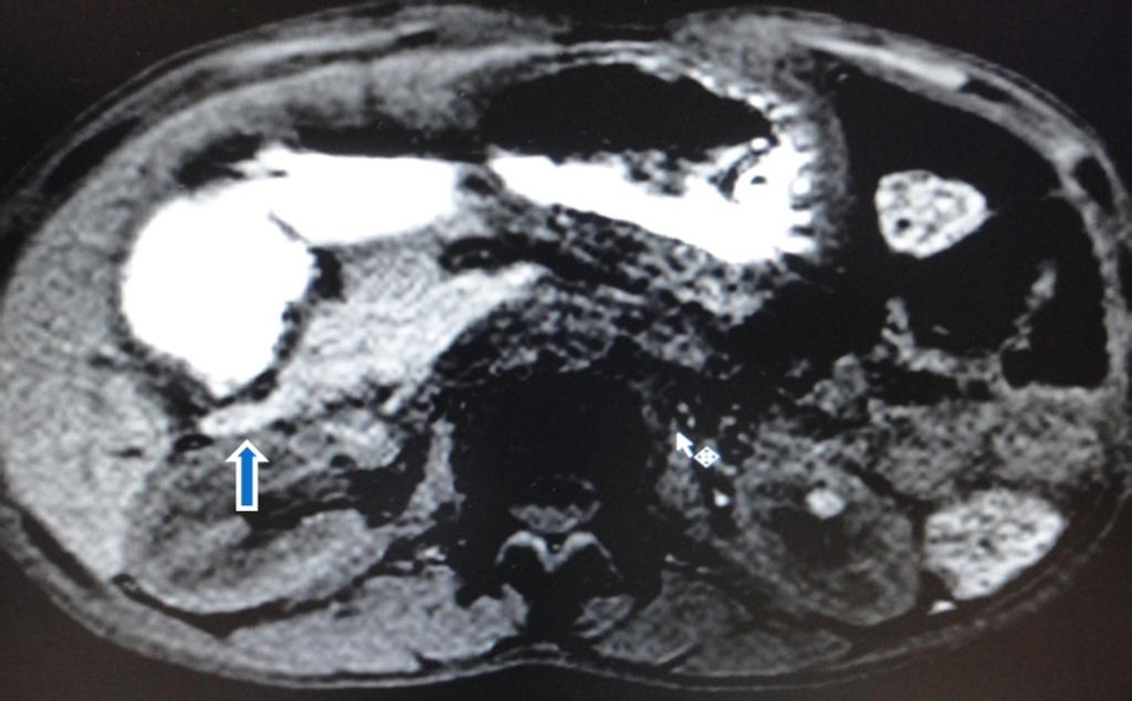 Fig. 3: A young male presented with long history of recurrent vomiting immediately after food intake with distension
