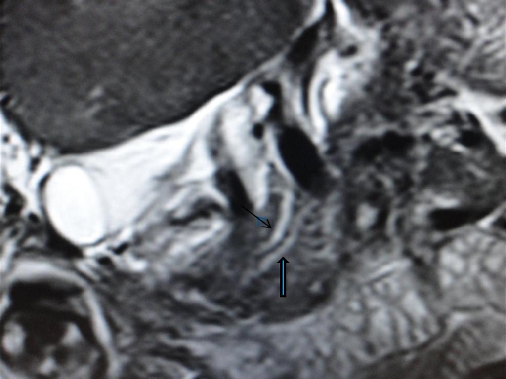 Fig. 10: MRCP image shows prominent CBD upto its lower end with its termination at the minor papilla.