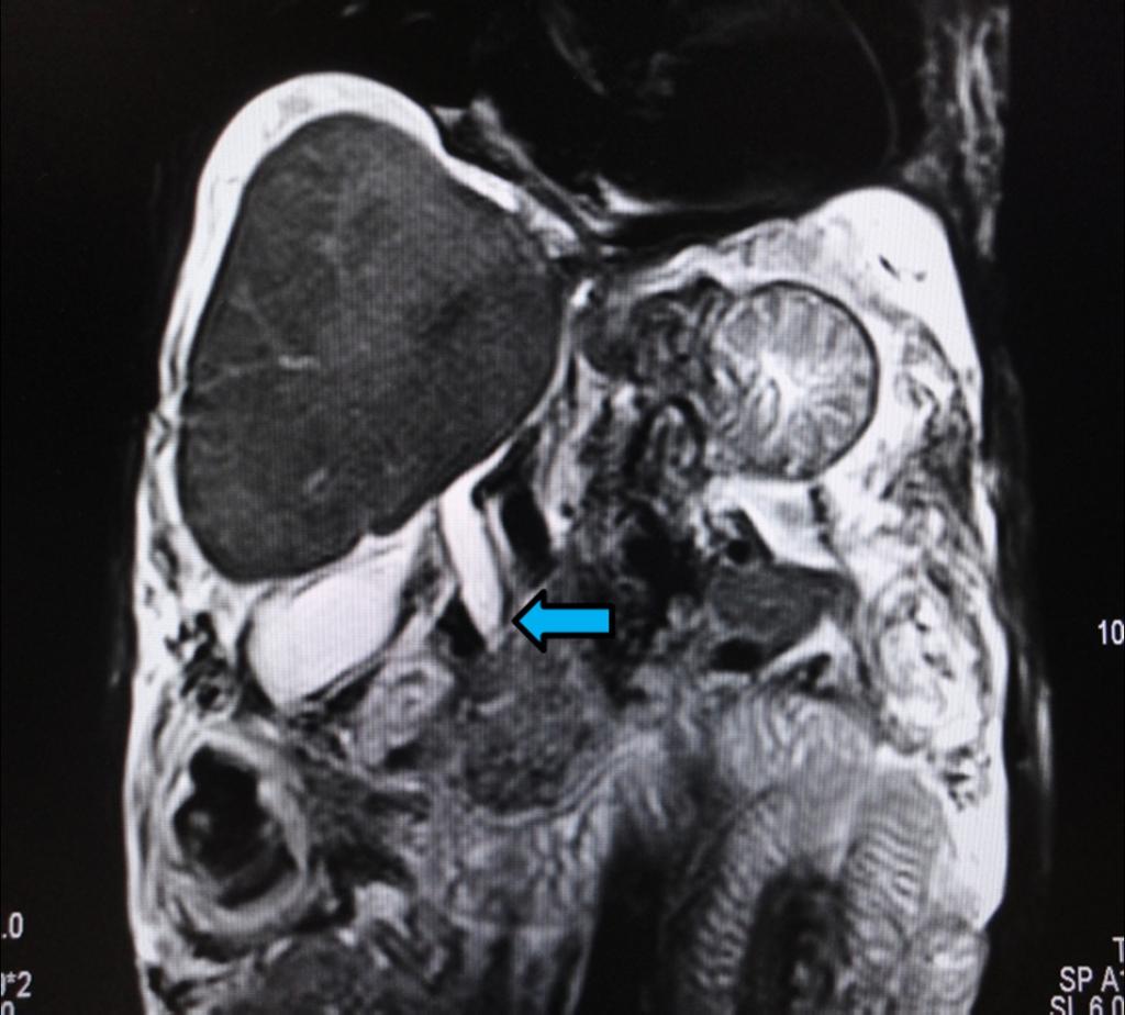 Fig. 9: A 45 year old male patient presented with a history recurrent jaundice.