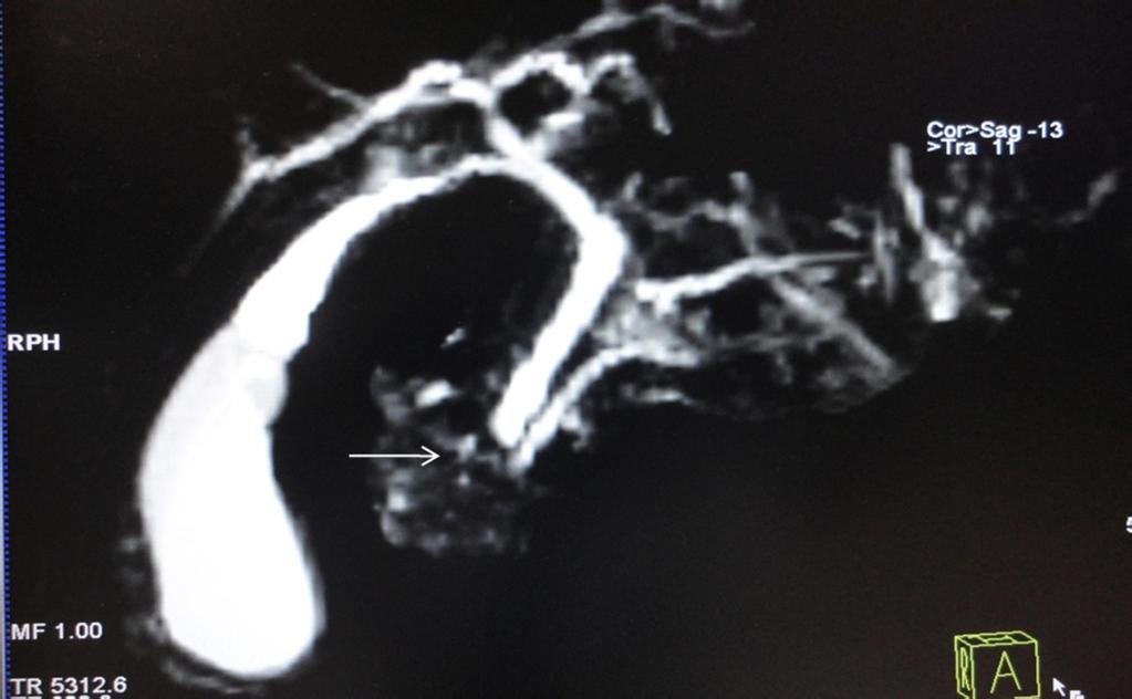 Fig. 6: Post Fentanyl MRCP shows distension of pancretico-biliary ductal system due