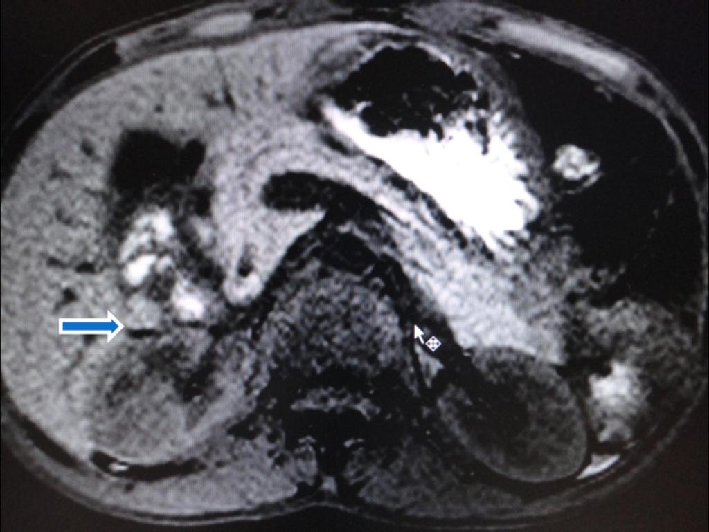 Fig. 4: A young male presented with long history of recurrent vomiting immediately after food intake with distension