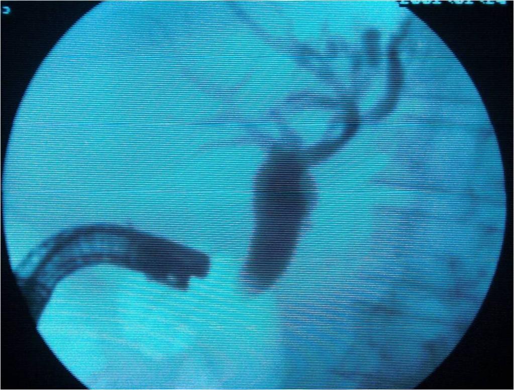 Fig. 11: Repeat ERCP through minor papilla was later successful