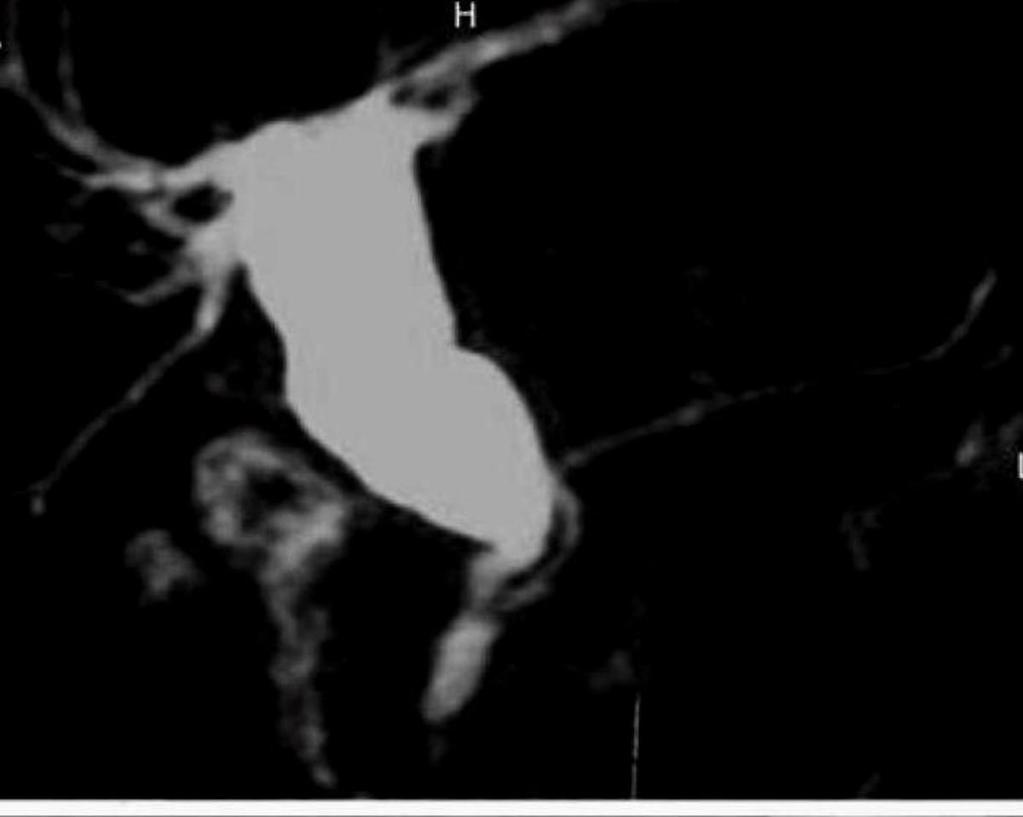 Fig. 7: coronal MRCP image showing type 1 choledochal cyst with long