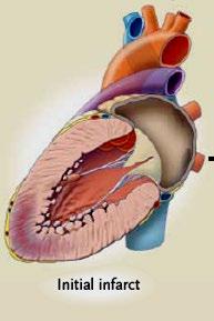 Acute MI Cardiogenic