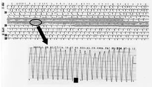 Fig.5. Electrocardiogram on second admission. Fig.6. The electrocardiogram when syncope occurred. 4.4 mm.
