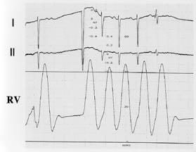 Fig.7. Recording of right ventricular pressurewave.