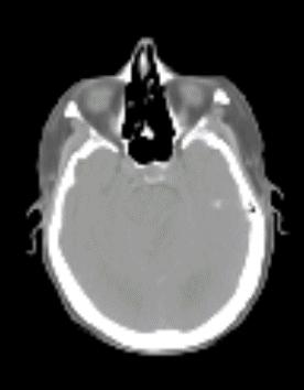 fused with the planning CT dataset The orbits, optic nerves, optic chiasm, and scalp were also contoured