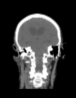 to each treatment fraction and repositioned for treatment Case Study: Whole Brain / Boost Case Study: