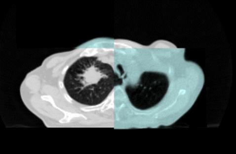 Pre-Treatment CT Images Reference CT Images Tumor Response The Patient s measured Tumor Response was measured for the first three fractions A a
