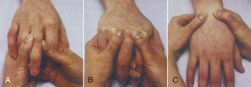 Palpation Feel for normal anatomy Feel the different carpal bones Palpate the anatomical "snuff box, is there