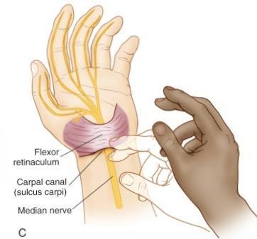 Tap over anterior wrist (volar carpal ligament) Tinel s Test Reproduce pain in the distribution of the median nerve.