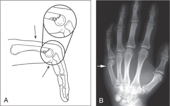 Boxer s Fracture Fracture to the fifth metacarpal caused by striking a hard object (From Armstrong, A.D. and others.
