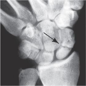 Hyperextension of the wrist Occurs when patient falls on outreached hand. Scaphoid Fracture (Stat!