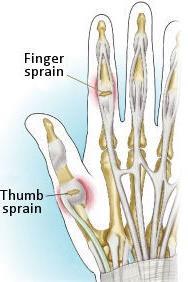 Finger and Thumb Sprain Results from direct trauma causing hyperextension or hyperflexion of one