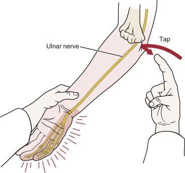 Tap the groove between the olecranon and medial epicondyle Positive if a