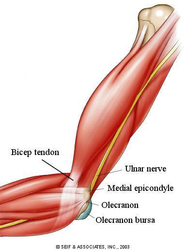 Lateral Epicondylitis An injury overuse or repetitious extension of the wrist or rotation of the forearm Activities such as