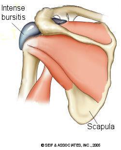 Cause of repetitive overhead activity aggravating the subacromial bursa Subacromial