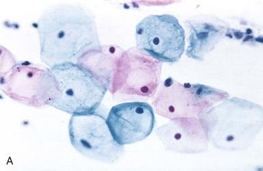 Introduction Glandular cell abnormalities on cervical cytology include 1 :