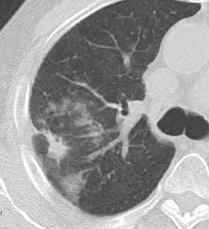 SBRT Early changes F, 75 y/o, NSCLC; 4 months