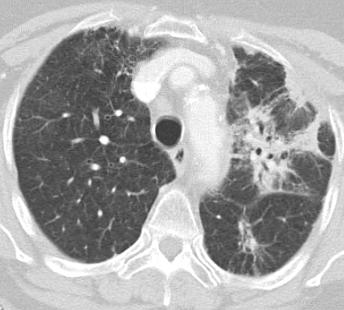 SBRT Late changes M, 75 y/o, NSCLC; 7 months