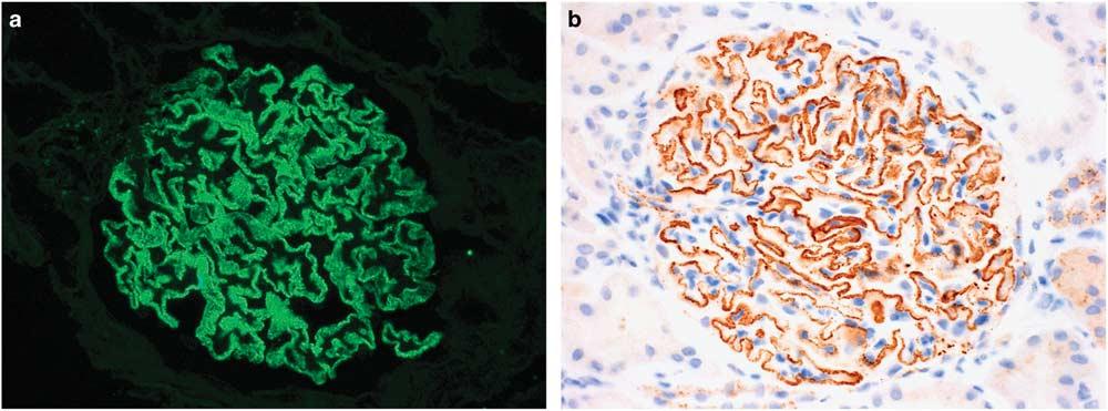 (b and c): Glomeruli from two different cases of PLA2R-associated membranous glomerulopathy demonstrate the range of normal THSD7A staining that can be seen in cases of membranous glomerulopathy from