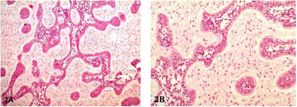 7 It is not infrequent to observe squamous differentiation or microcystic changes in the central areas (Figures 1A 