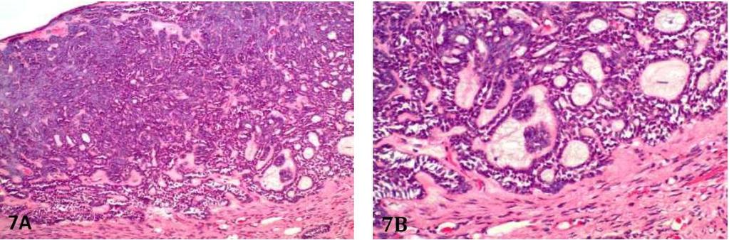 North American Journal of Medicine and Science Jan 2012 Vol 5 No.1 23 Figure 7. Basal cell ameloblastoma. 7A. Nests of interconnecting ameloblastic epithelium form a netlike pattern.