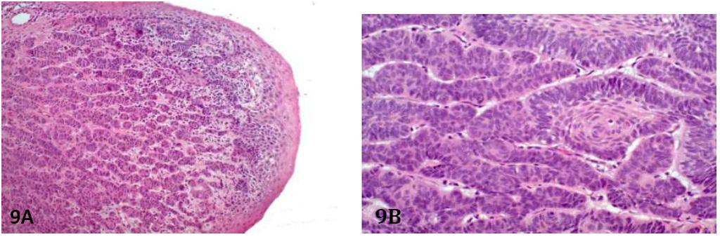 13 Three subtypes of unicystic ameloblastoma are recognized.