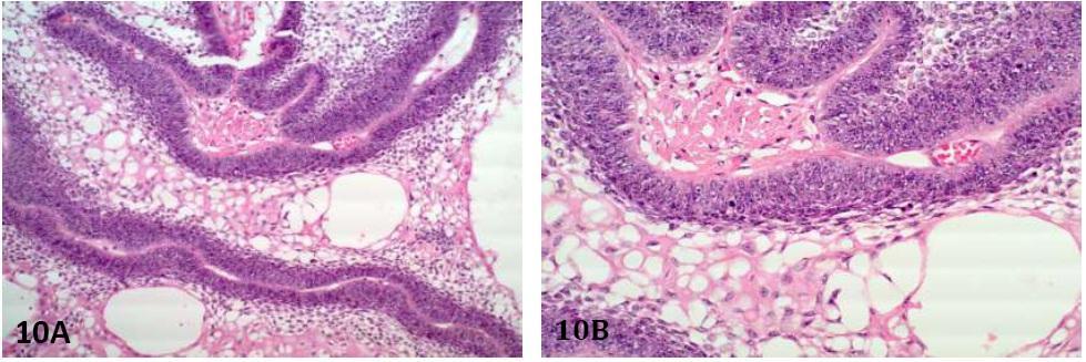 24 Jan 2012 Vol 5 No.1 North American Journal of Medicine and Science Figure 10. Ameloblastic carcinoma. 10A.
