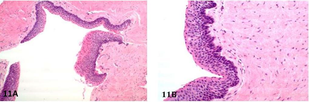 Increased mitotic activity, cellular pleomorphism and disarray of the basal cells are observed. Figure 11. Odontogenic keratocyst. 11A.
