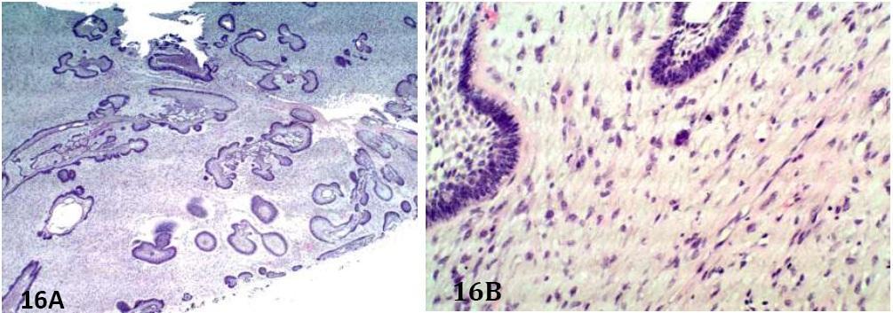 resembles primitive dental papillae (Figures 14A and 14B). At times, areas of hyalinization may be found at epithelial-mesenchymal interfaces.
