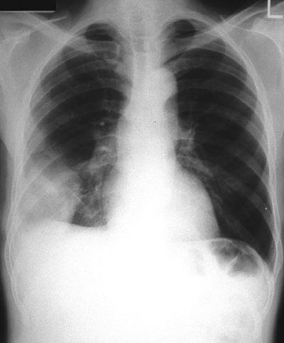 Chest radiograph showing