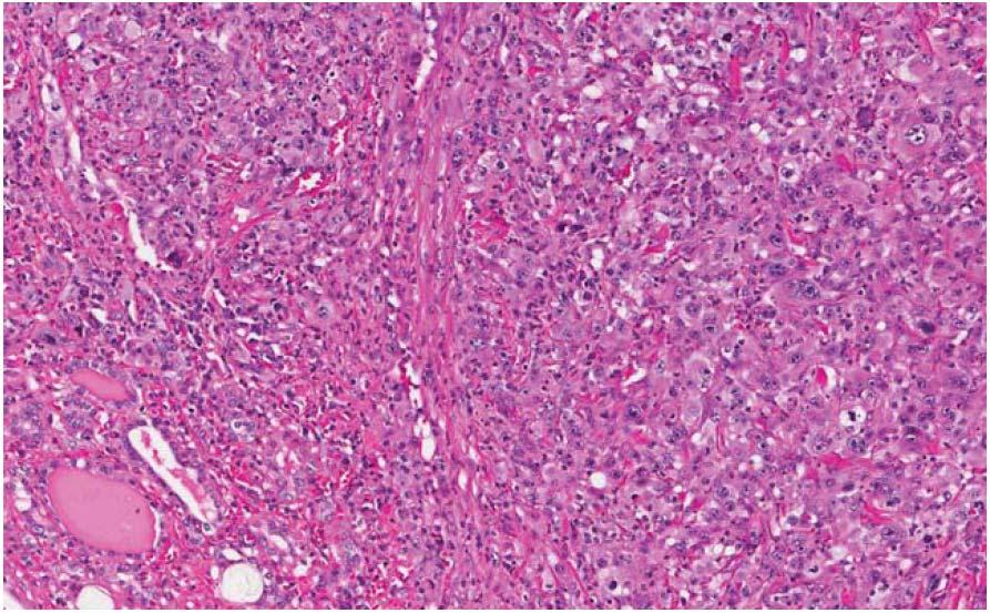 Anaplastic thyroid carcinoma Lastra RR, LiVolsi VA, Baloch ZW. Cancer (Cancer Cytopathology) 2014;122:484-503 Figure 12.