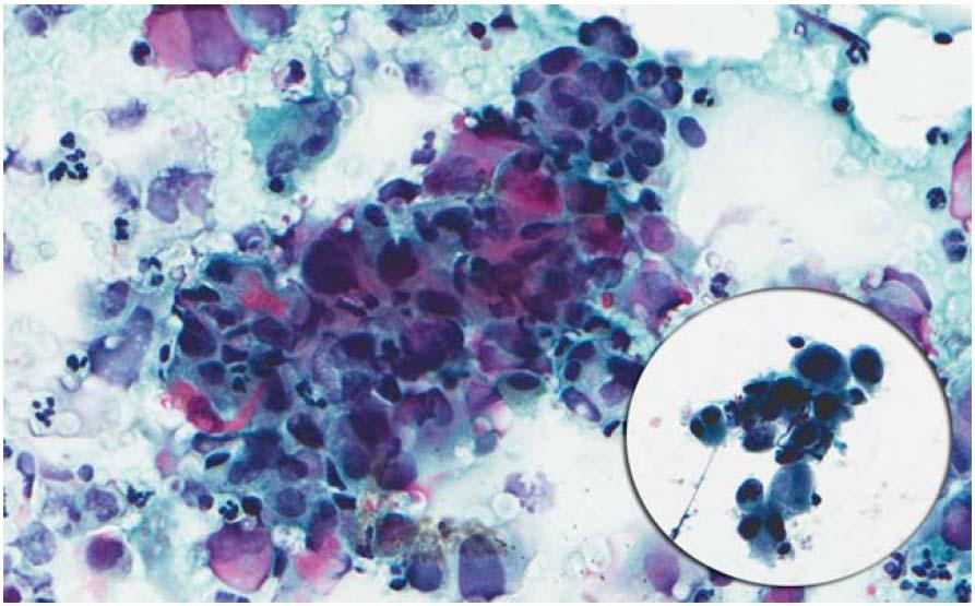 Anaplastic thyroid carcinoma Lastra RR, LiVolsi VA, Baloch ZW. Cancer (Cancer Cytopathology) 2014;122:484-503 Figure 13.